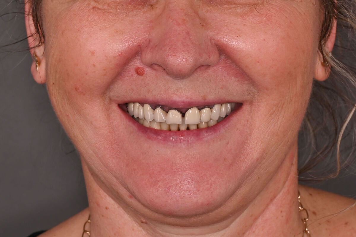 Zâmbet lateral stanga_înainte